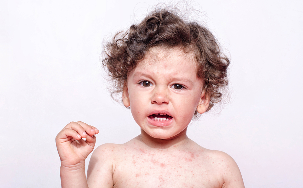 Would you Recognise an Allergic Reaction? | Kiddipedia