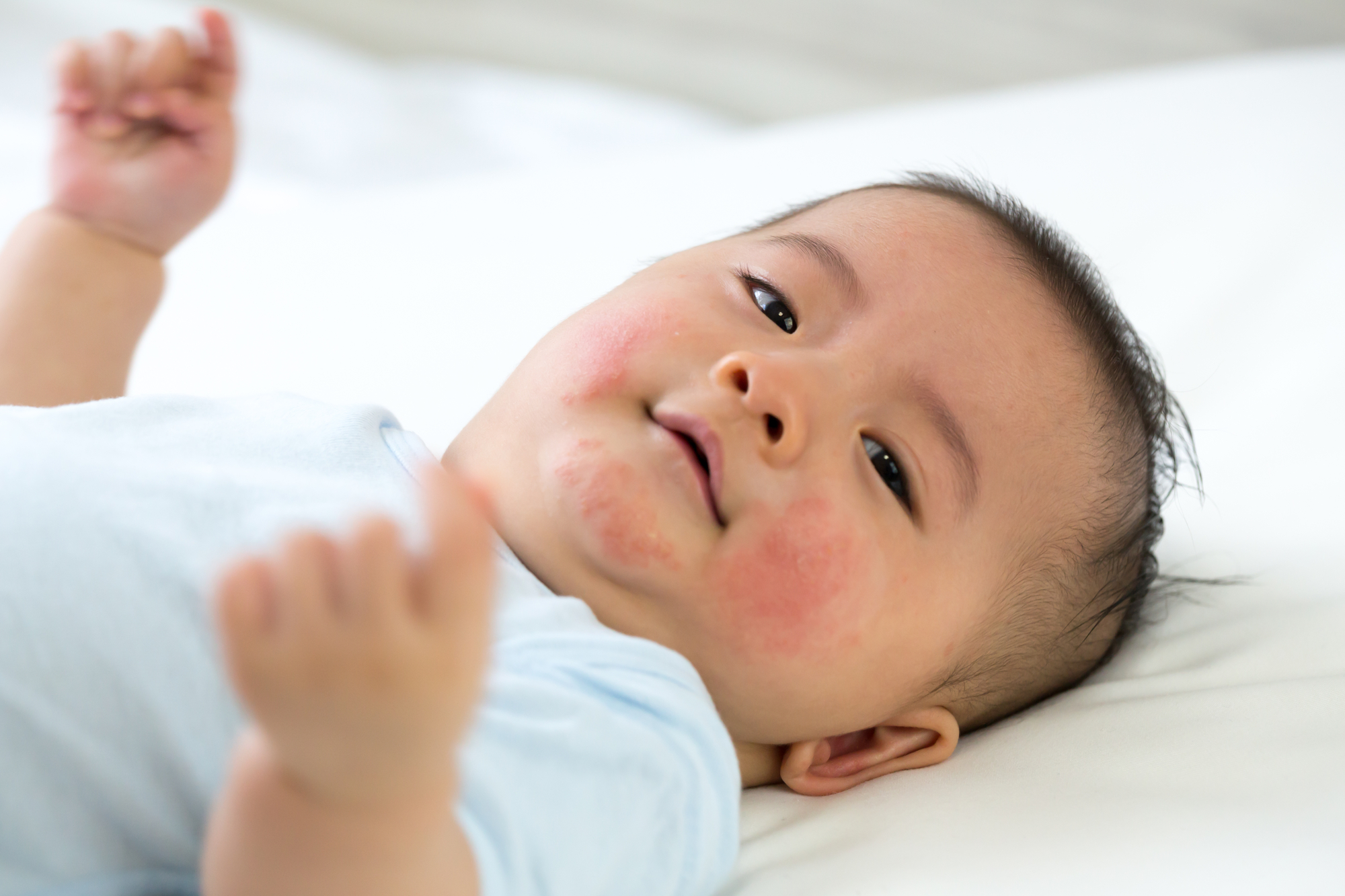 newborn-baby-hives-prevention-causes-treatment-kiddipedia